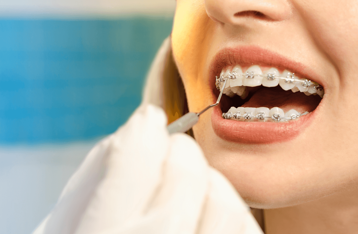 Braces Unveiled: Exploring the Latest Trends and Techniques for Orthodontic Treatment