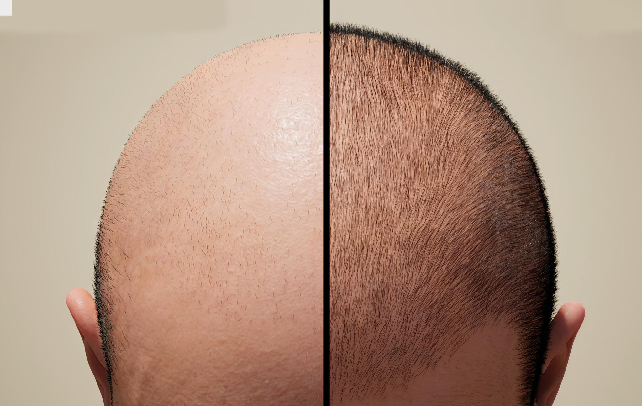 Excellent Features of a Good Hair Transplant Clinic