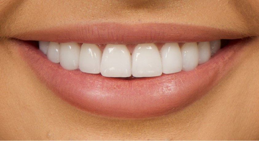 Why Veneers Are a Popular Choice for Smile Makeovers in London 